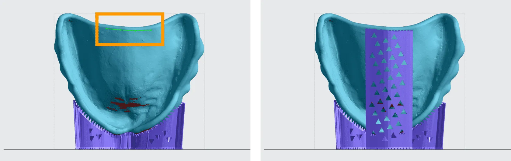 Depending on the size of the denture base, additional supports may be required. Depending on the size of the denture base, additional supports may be required.