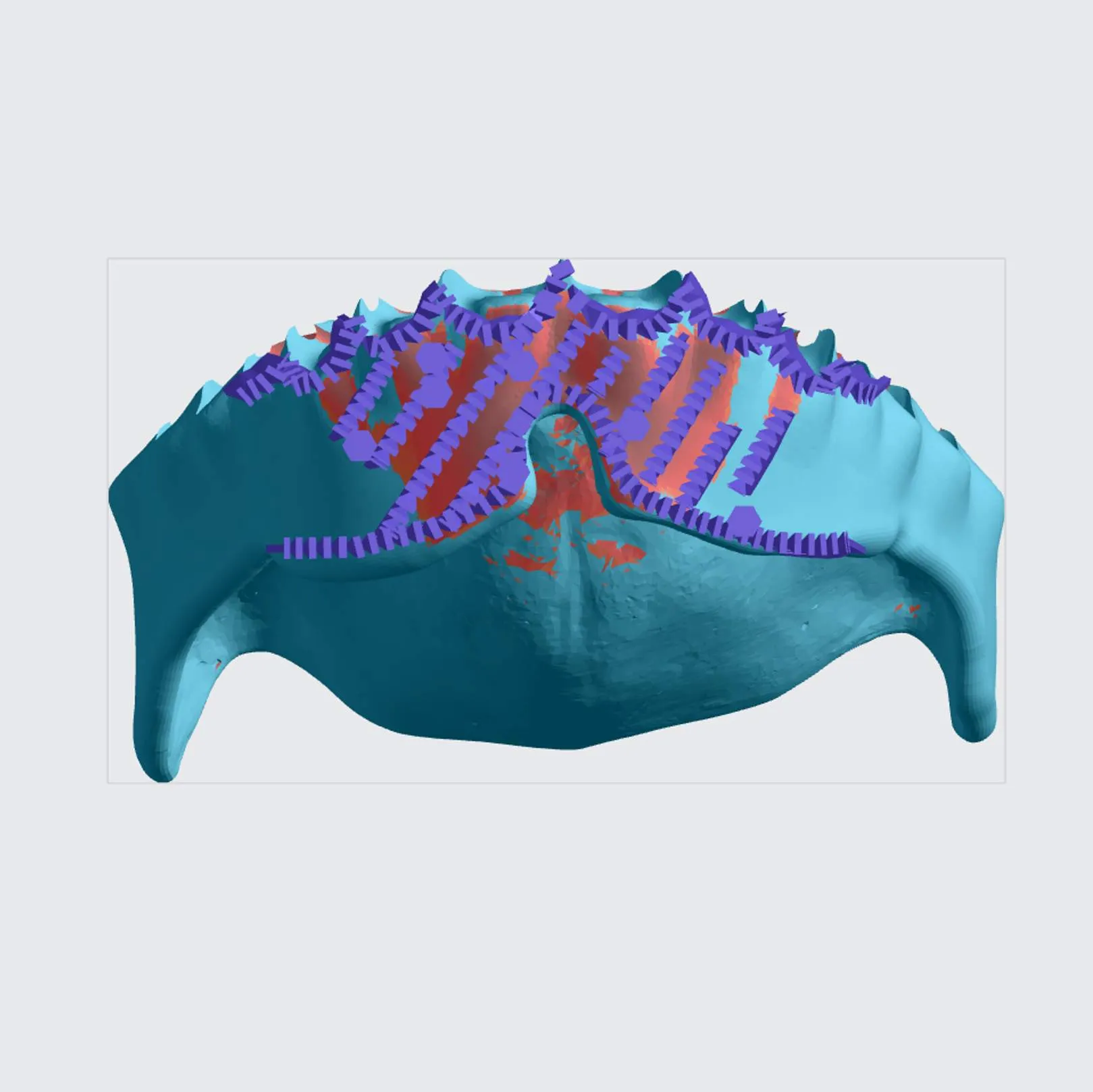 Upper Denture (bottom view) Upper Denture (bottom view)