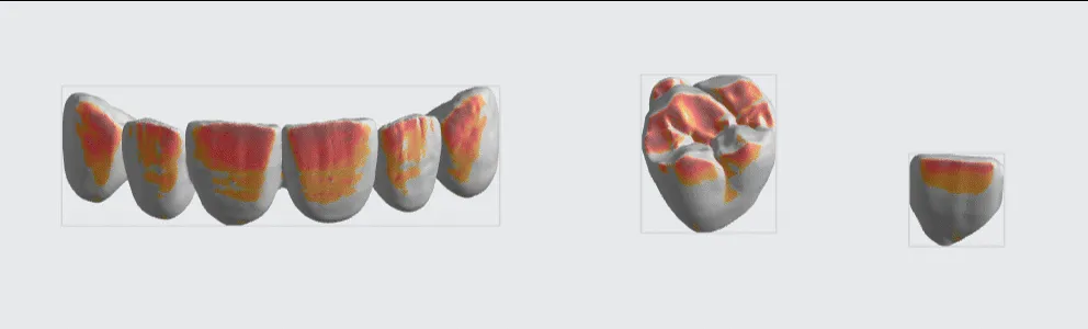 Crown and veneers showing minimal overhangs Crown and veneers showing minimal overhangs