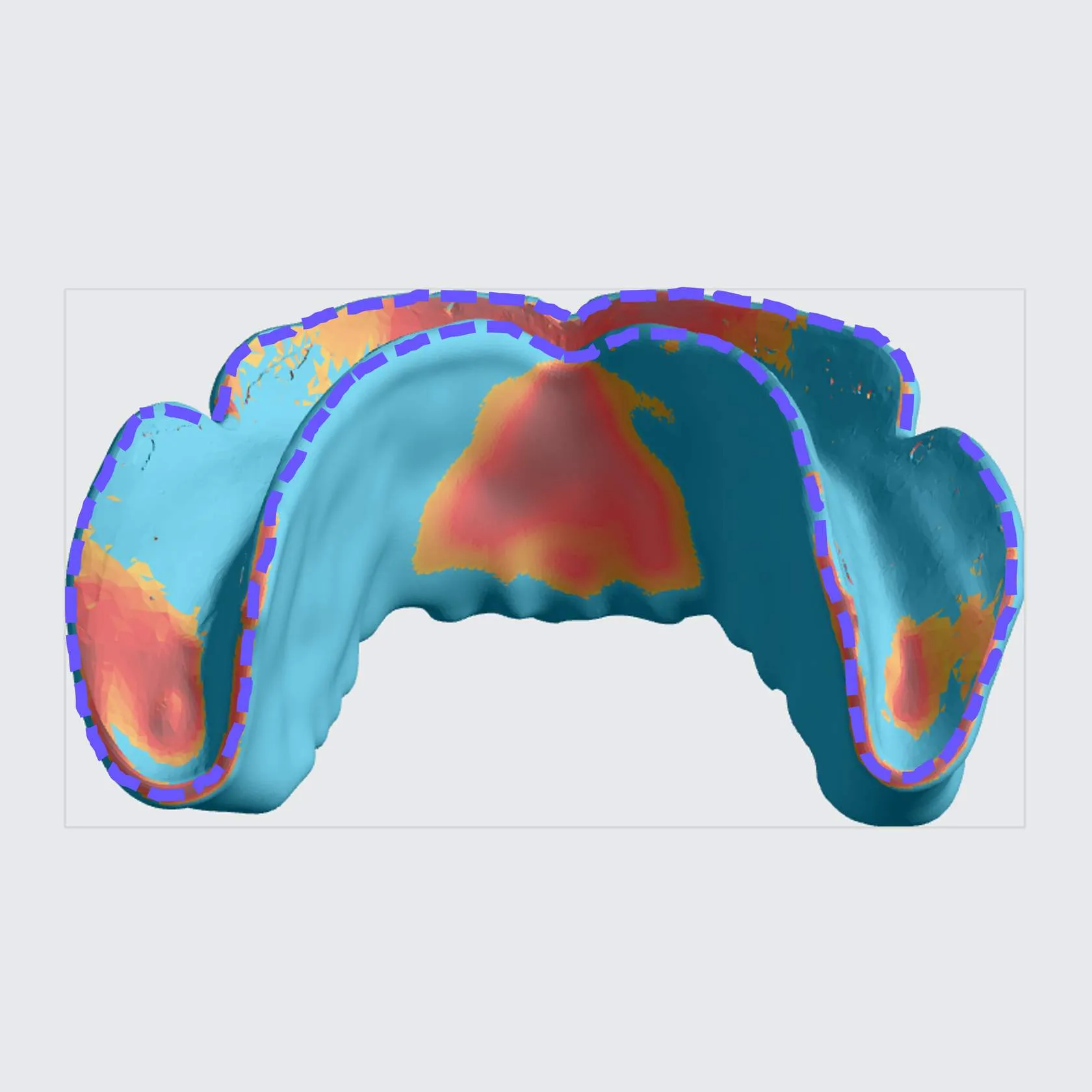 Lower Denture Base Lower Denture Base