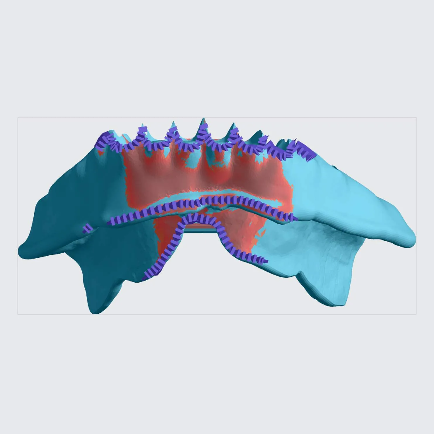 Fence Supports on Tooth Pockets on Lower Denture Fence Supports on Tooth Pockets on Lower Denture
