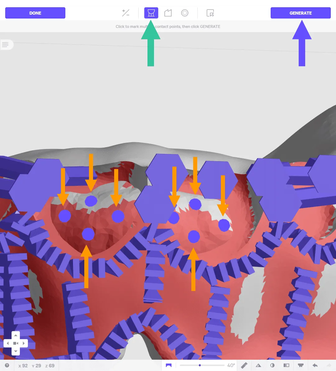 Supporting tooth channels