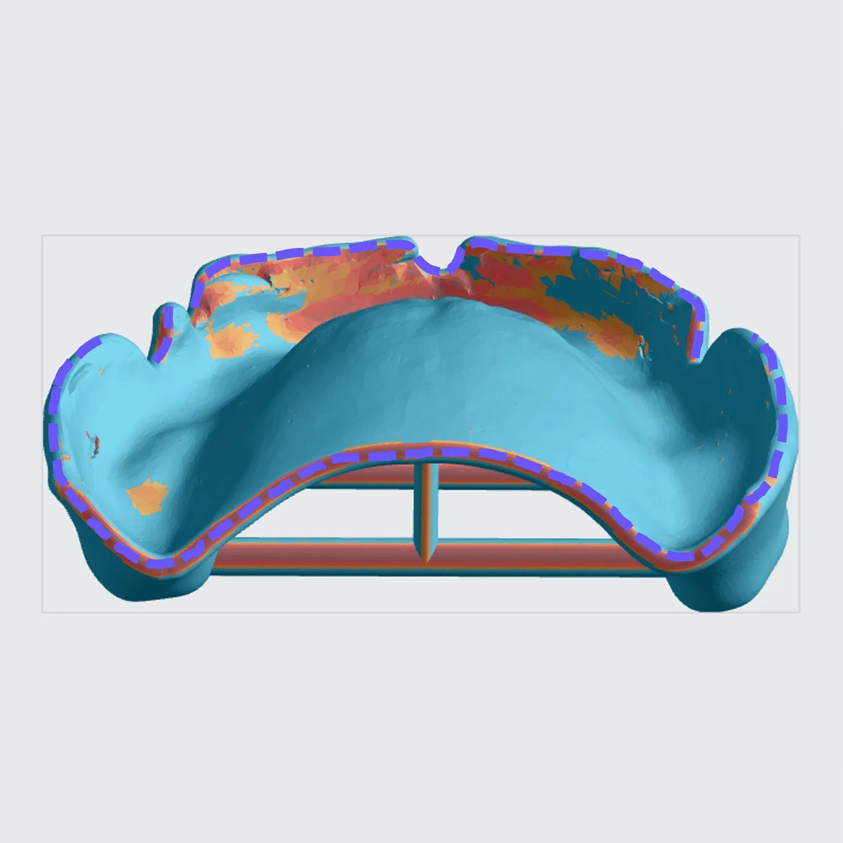 Upper Denture Base Upper Denture Base