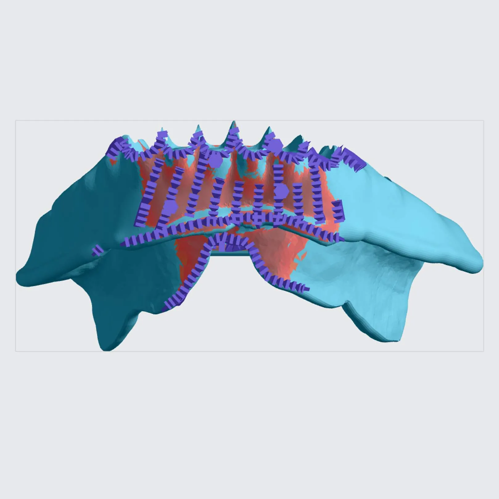 Lower Denture (bottom view) Lower Denture (bottom view)