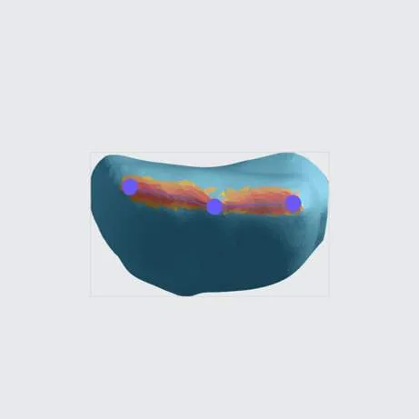 Points on incisal edge