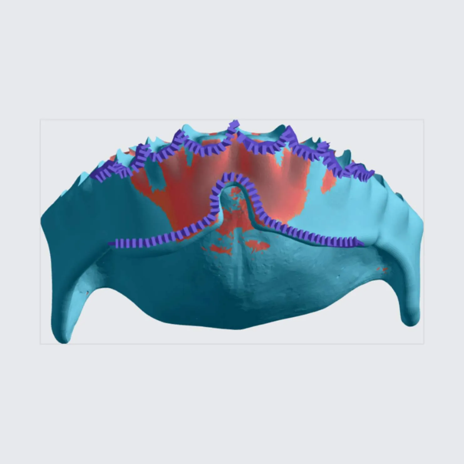 Fence Supports on Tooth Pockets on Upper Denture Fence Supports on Tooth Pockets on Upper Denture