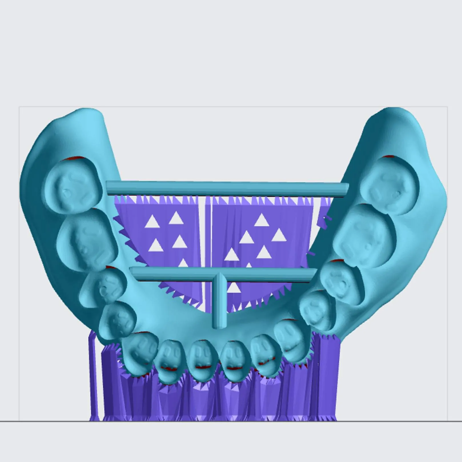 Lower Denture (front view) Lower Denture (front view)