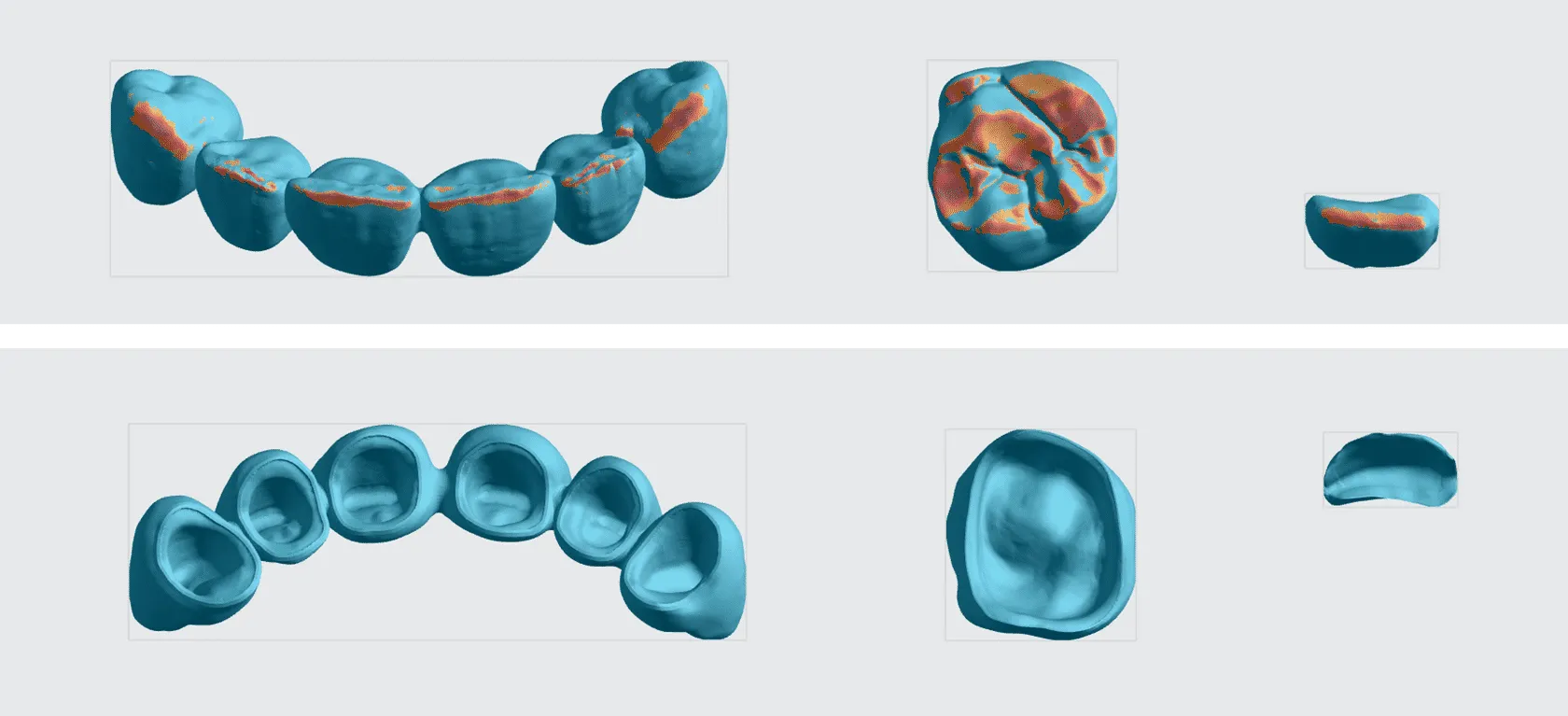 Occlusal surfaces are oriented to minimize overhangs. Margin and interface are free of overhangs. Occlusal surfaces are oriented to minimize overhangs. Margin and interface are free of overhangs.