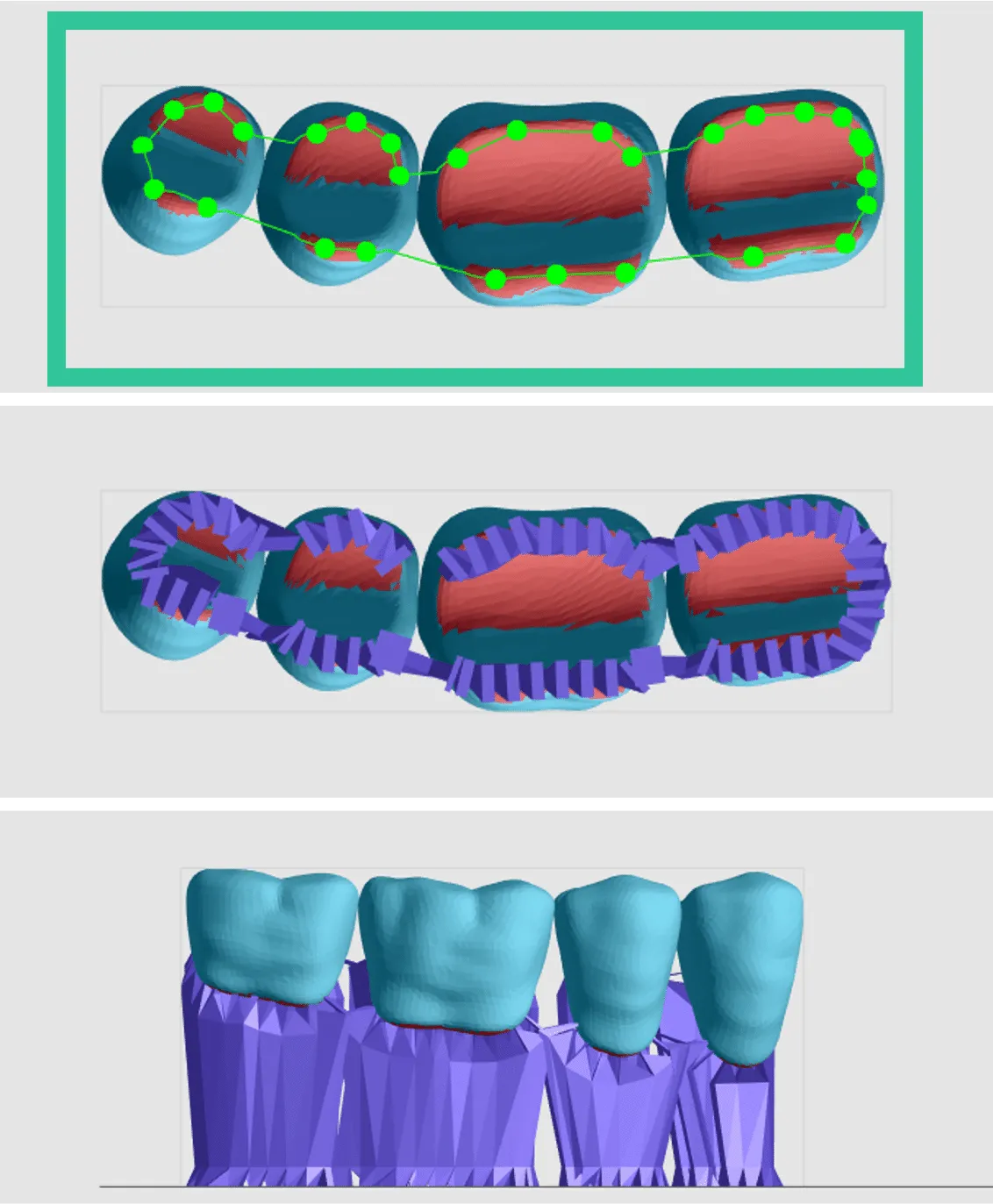 Fence supports on posterior teeth Fence supports on posterior teeth