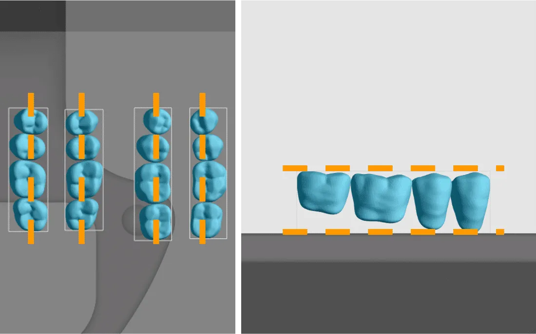 Parallel orientation of posterior teeth blocks Parallel orientation of posterior teeth blocks