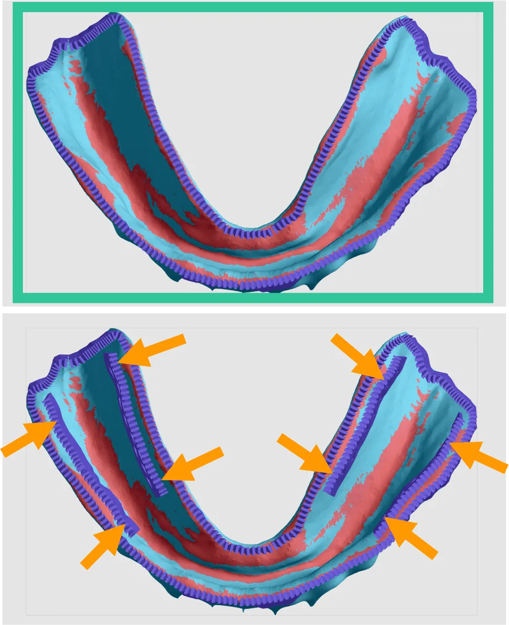 Mandibular fence placement