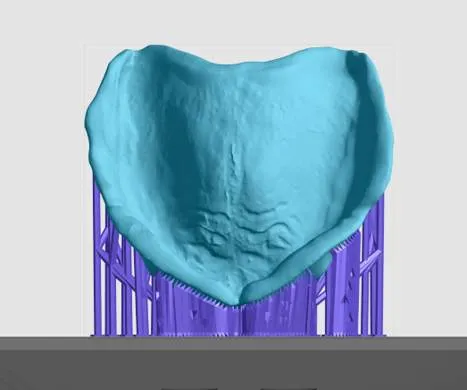 Near vertical oriented denture