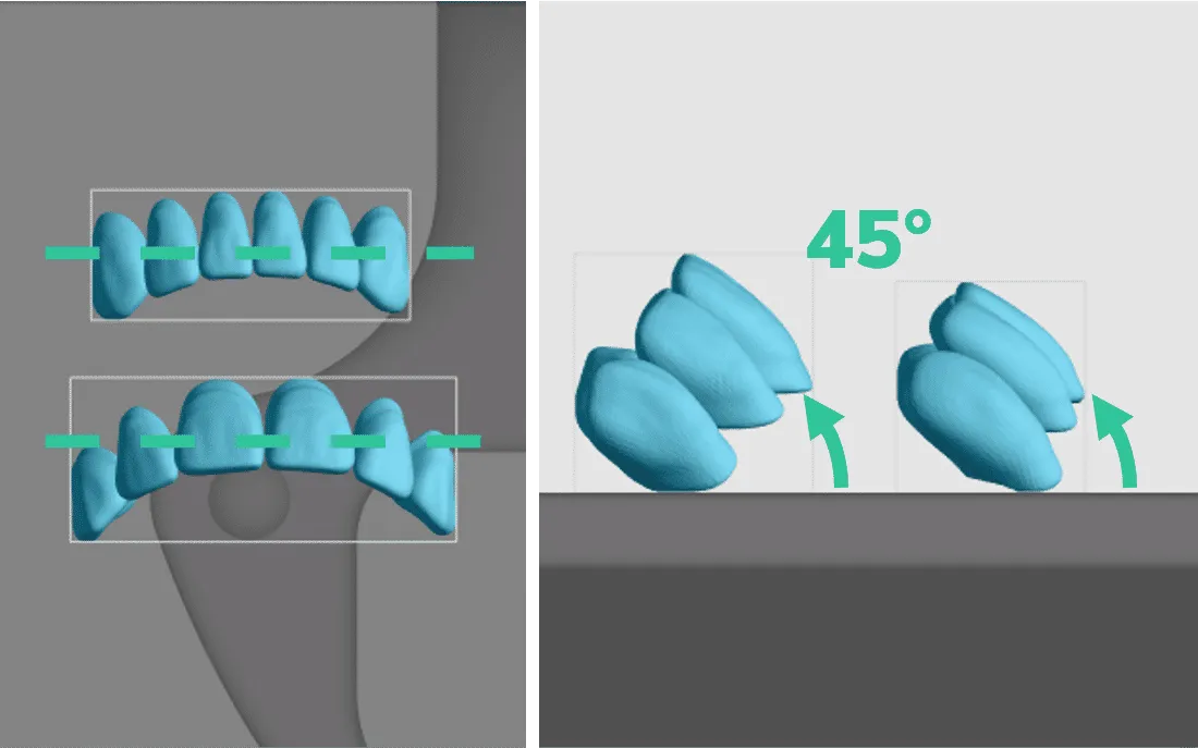 Final orientation of anterior teeth blocks Final orientation of anterior teeth blocks