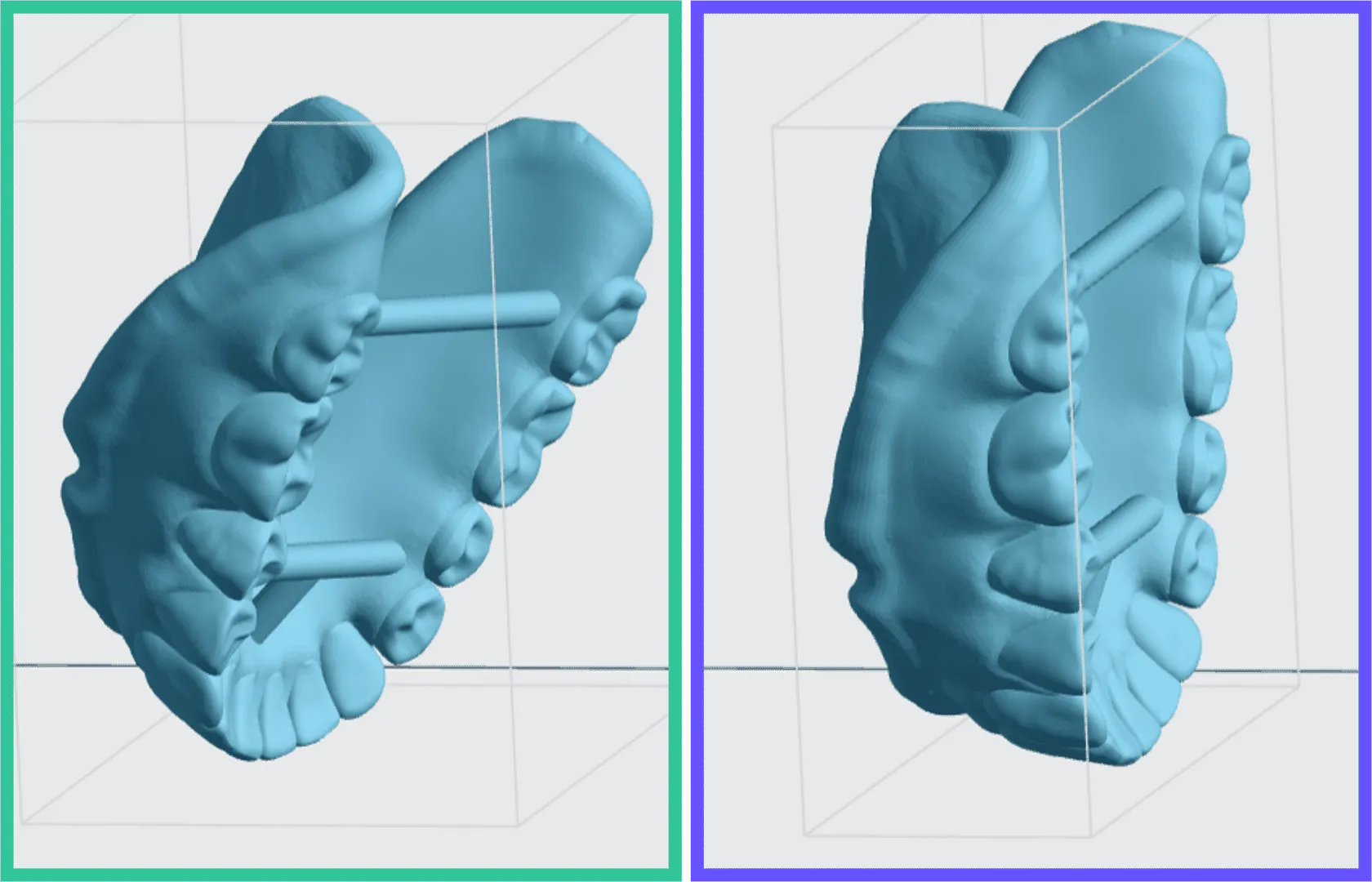Try-in denture oriented at 60 and 90 degrees Try-in denture oriented at 60 and 90 degrees