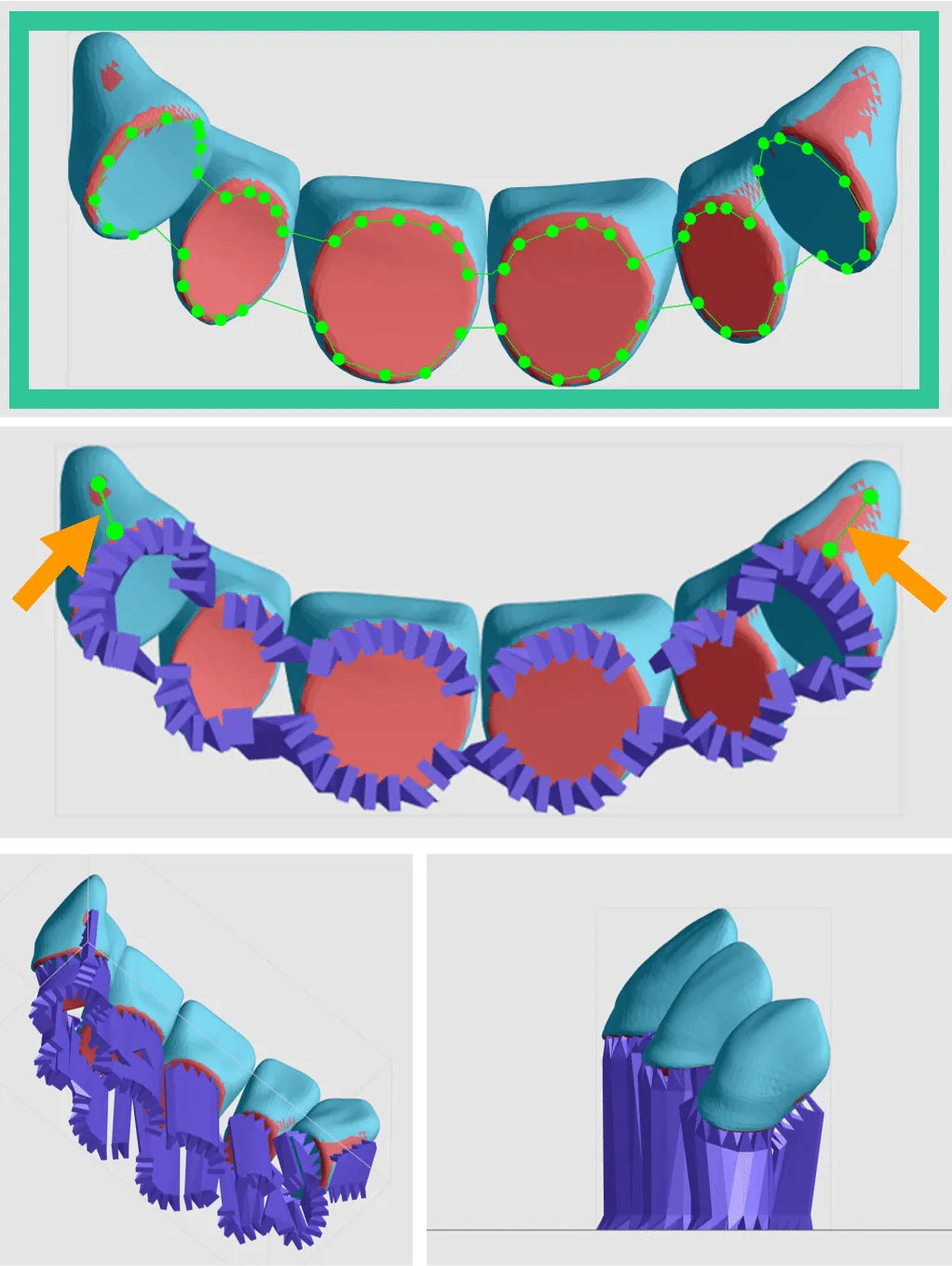 Fence supports on anterior teeth Fence supports on anterior teeth