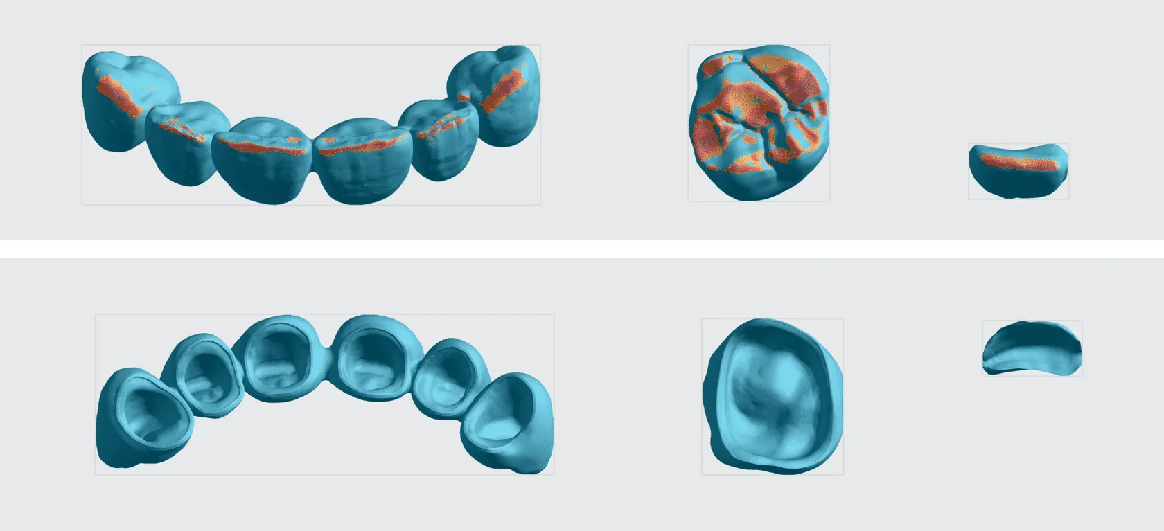 Occlusal surfaces are oriented to minimize overhangs. Margin and interface are free of overhangs. Occlusal surfaces are oriented to minimize overhangs. Margin and interface are free of overhangs.