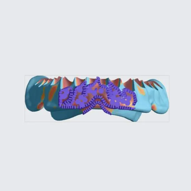 Lower denture (bottom view) Lower denture (bottom view)