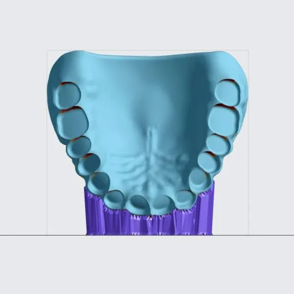 Upper denture (front view) Upper denture (front view)