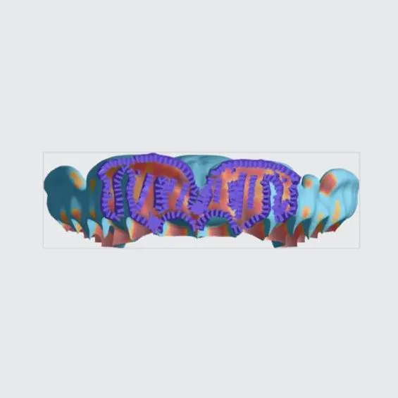 Upper denture (bottom view) Upper denture (bottom view)